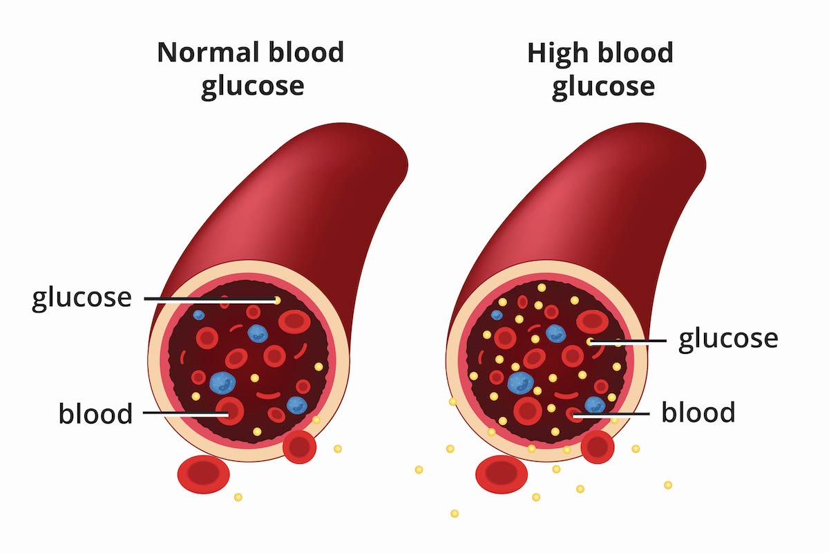 Blood Glucose